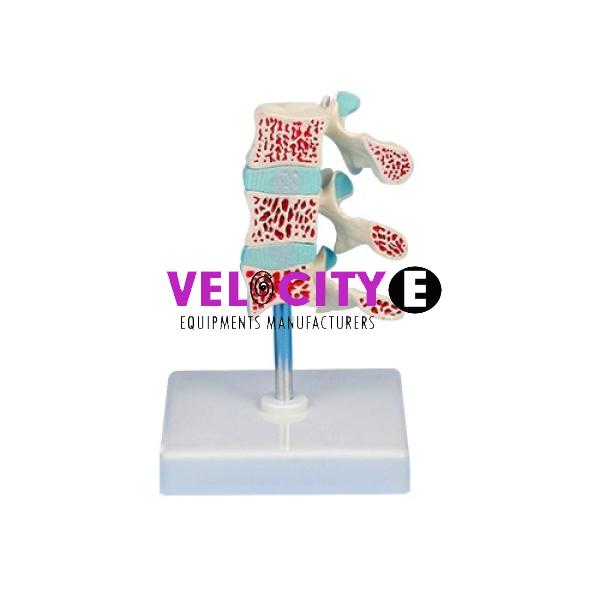 Osteoporosis Model